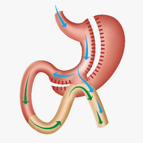 Bipartición del Tránsito Intestinal